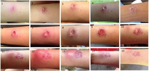 My Battle With A Flesh Eating Parasite Called Leishmaniasis In The