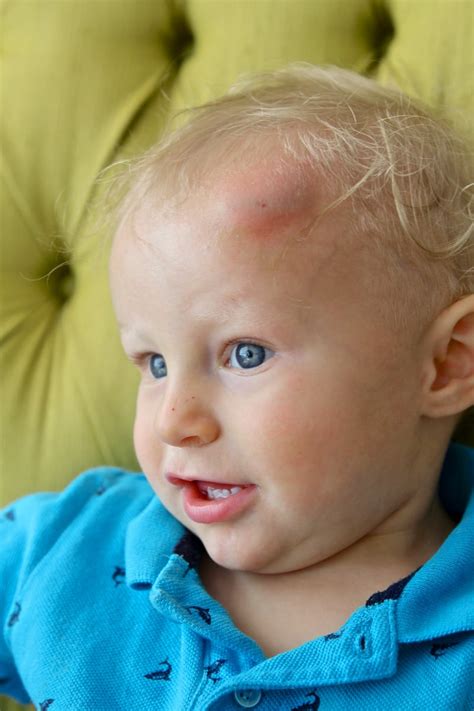 Help For Toddler Bumps And Bruises Paging Supermom