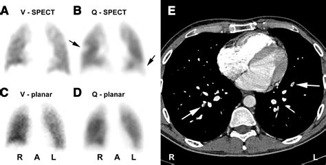 Figure Tomographic Imaging In The Diagnosis Of Pulmonary Embolism A Comparison Between V Q