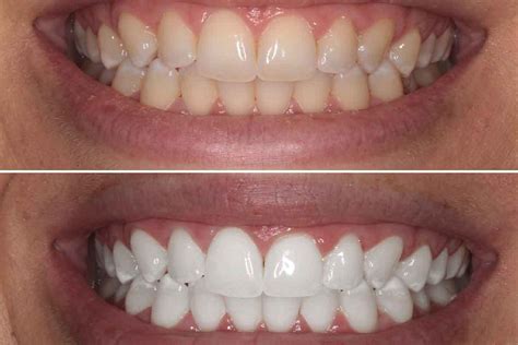 Professional Teeth Whitening In Brooklyn 11229 Eco Dental Ny