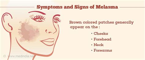 Melasma Causes Symptoms Risk Factors Diagnosis Treatment Prevention