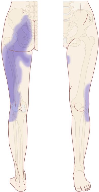 Typical Pain Referral Pattern Of Sacroiliac Joint Pain Illustration