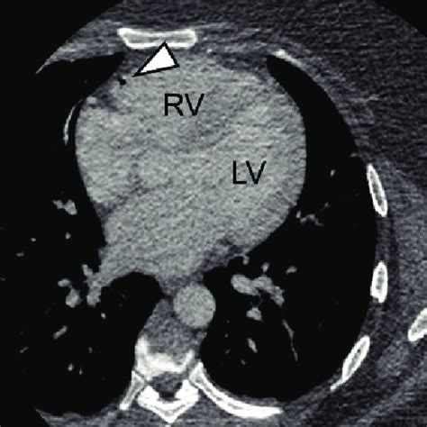 Pdf Air Embolism After Peripheral Iv Contrast Injection