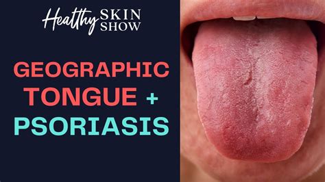 What Is Geographic Tongue Is It A Sign Of Psoriasis Jennifer Fugo