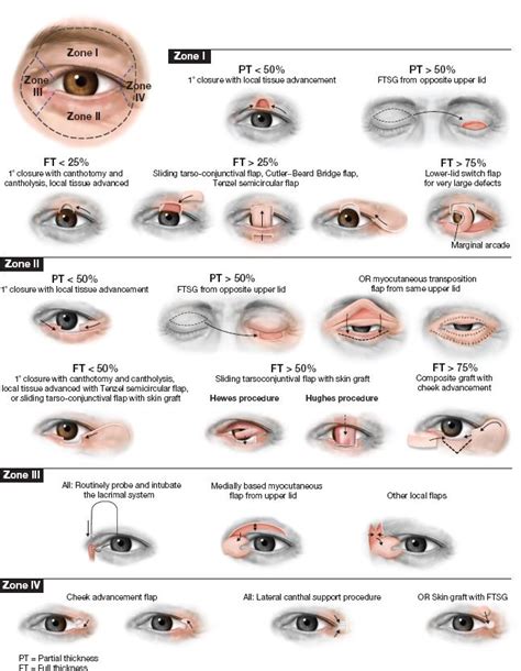 Eyelid Reconstruction Plastic Surgery Key
