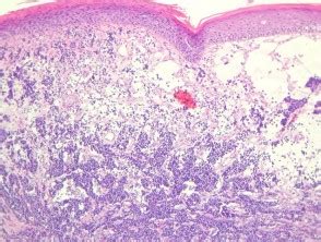 This is a very rare kind of skin cancer that merkel cell carcinoma symptoms. Merkel cell carcinoma pathology | DermNet NZ