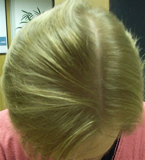 The Hair Loss Centre Female Hair Loss Treated Pictures