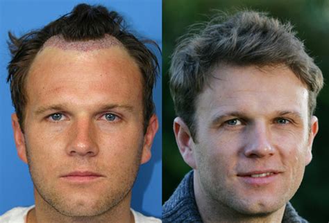 Celebrity Hair Loss Celebrities Dealing With Hair Loss