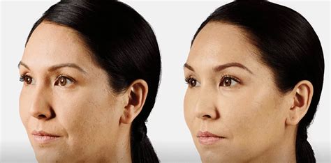 Cheek Enhancement Fillers Cutis Dermatology