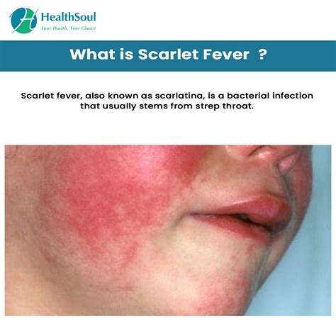 Scarlet Fever Symptoms And Treatment Healthsoul