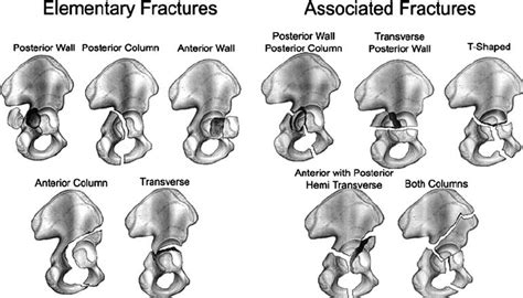 Acetabular Fractures Presentation And Treatment Bone And Spine