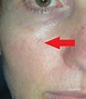 Skin Cancer Cheek with Local Flap Repair - Dr. Damian Marucci cosmetic ...