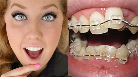How Do You Know Which Type Of Braces Is Right For You Doctor Invisalign