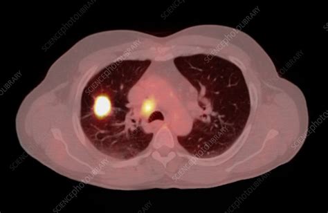 Non Small Cell Lung Cancer CT PET Scan Stock Image C007 1648