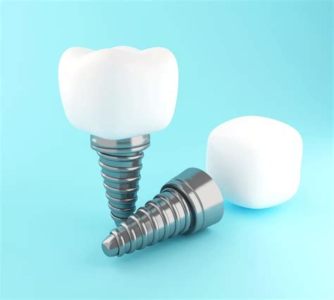 Partes del Implante Dental Clínica Dental González Baquero