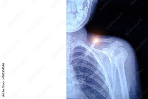 X Ray Image Broken Collarbone Person Stock Photo Adobe Stock