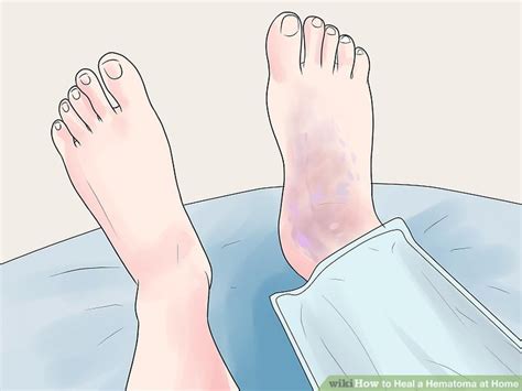 3 Ways To Heal A Hematoma At Home Wikihow