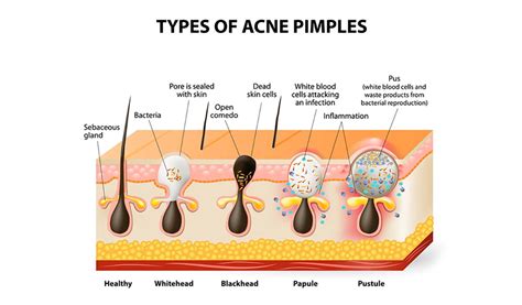 Acne Vs Zits Vs Pimples Whats The Difference And Tiege Hanley