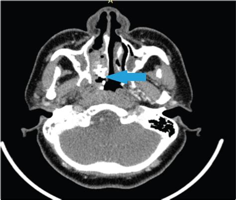 A Stony Coincidence In The Nose Mimicking Nasopharyngeal Carcinoma