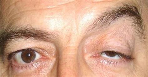 Droopy Eyelids Ptosis Pediatric Ophthalmology Pa