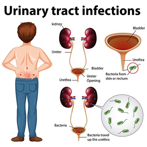 Understanding Urinary Tract Infection Uti Causes And Symptoms