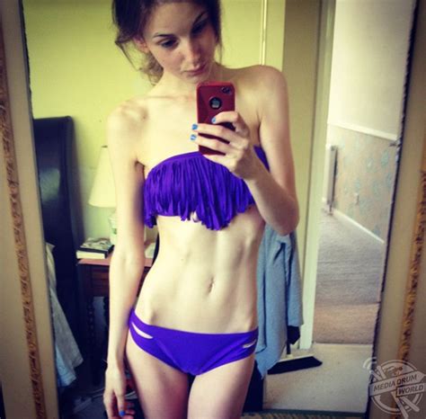 Anorexia Survivor Looks Absolutely Stunning As Her Fitness Schedule Has Got Her Weight Up