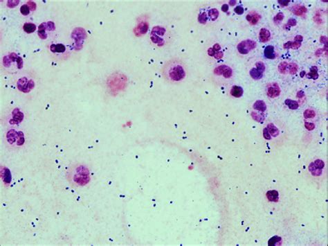 Streptococcus pneumoniae, s pneumoniae, pneumococcus, lobar pneumonia, pneumococcal pneumonia, otitis media, meningitis, pneumococcal streptococcus pneumoniae is a normal inhabitant of the human upper respiratory tract. Streptococcus pneumoniae (gram-positive diplococci) on the ...