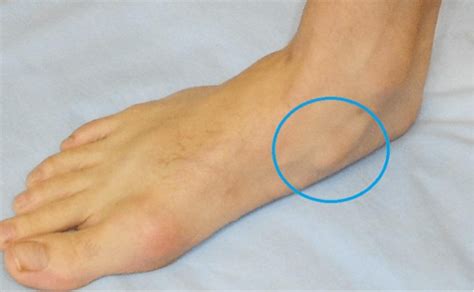 Accessory Navicular Syndrome Fort Worth Foot And Ankle Center