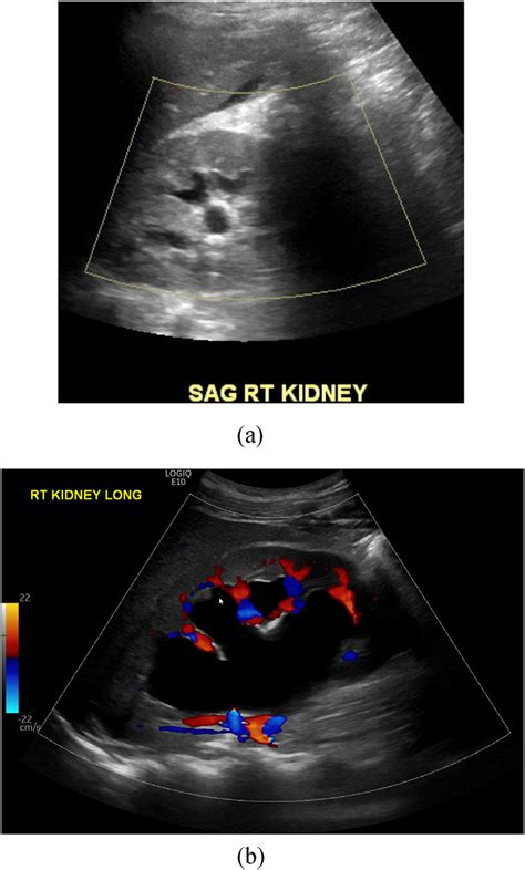A Sagittal Ultrasound Image Of The Right Kidney And Renal Pelvis 1