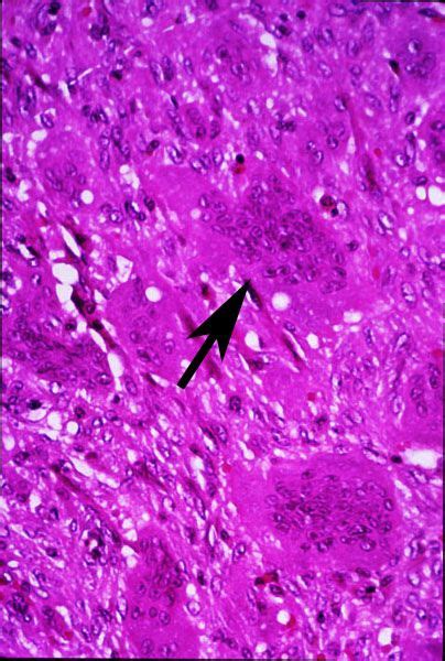 Giant Cell Tumor Pathology Bonetumor Org