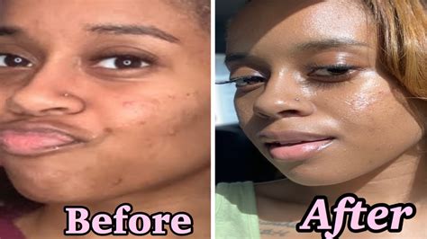 How I Cleared My Acne For Good In A Week Skin Care Routine 🥺 Youtube