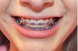 Where To Get Orthodontic Rubber Bands Photos