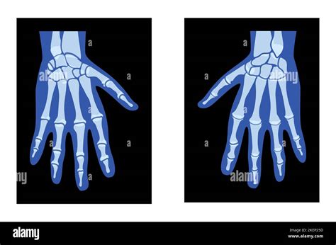 X Ray Manos Esqueleto Cuerpo Humano Huesos Adultos Roentgen Atrás