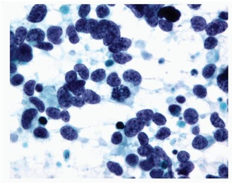 Small Cell Carcinoma Oncohema Key