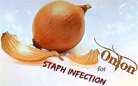 21 Natural Home Remedies For Staph Infection And More Information