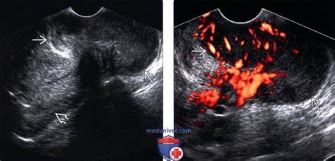 Диета рак шейки матки УЗИ, МРТ при раке шейки матки УЗИ, МРТ при раке шейки матки Диета рак шейки матки