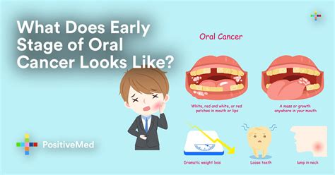 What Do Early Stages Of Oral Cancer Look Like Positivemed