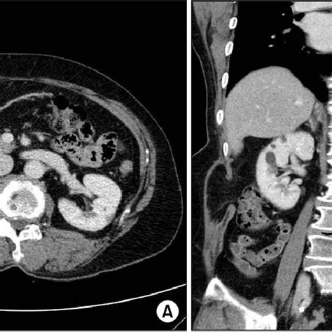 Radiologic Findings Of Lateral Abdominal Wall Defect Abdominopelvic Ct