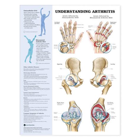 Carpal Tunnel Syndrome - Hand - Orthobullets