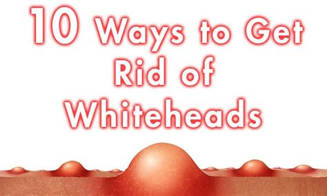 10 Ways To Get Rid Of Whiteheads Healthy Focus
