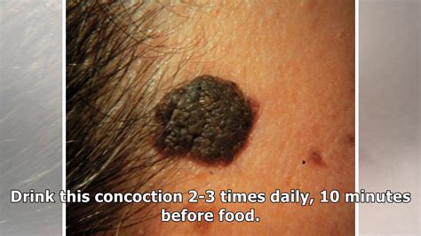 A Home Remedy For Seborrheic Keratosis That Works A Treat Youtube