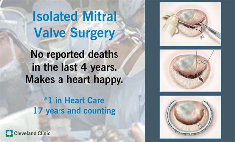 Mitral Valve Mitral Valve Heart Care Heart Surgery Cleveland Clinic