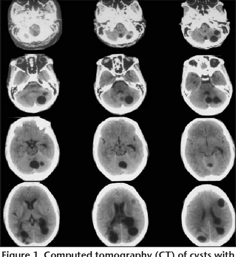 Figure 1 From Multiple Localization Of Intracranial Cyst Hydatid In An