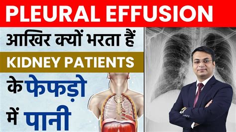 प्ल्यूरल इफ्यूशन फुफ्फुस बहाव क्या है Pleural Effusion In Hindi Dr