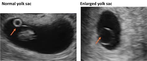 Yolk Sac 6 Weeks