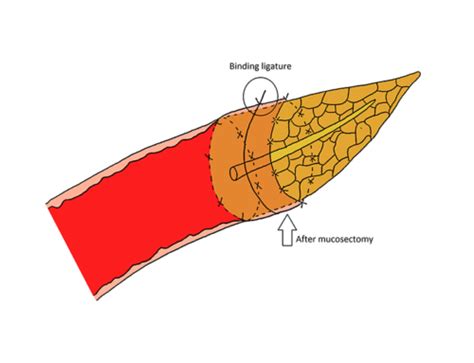 With Three Overlapping U Sutures The Pancreatic Anastomosis