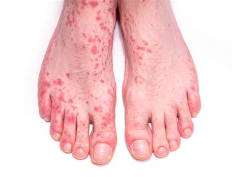 Scabies Rash Stock Photos Pictures And Royalty Free Images Istock
