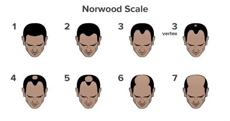 Male Pattern Baldness Watsons Barbers