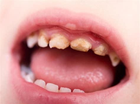 Tooth Decay In Children Costing The Nhs More Than £40m A Year Figures