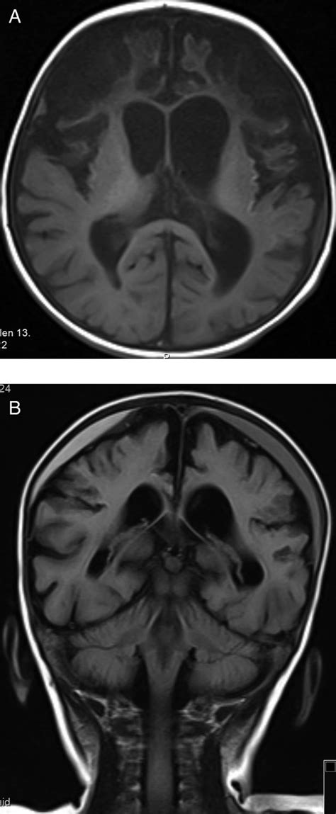 Cerebral Atrophy And Subdural Haemorrhage After Cerebellar And Cerebral